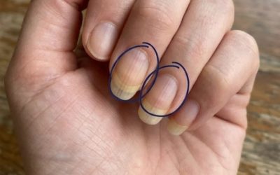 Si vous avez des stries sur vos ongles, en voici la signification