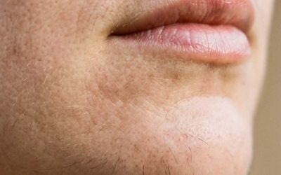 Les poils au menton d’une femme sont un signe de…
