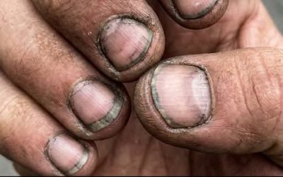 Comment appelle-t-on une personne qui a des ongles comme ça ?