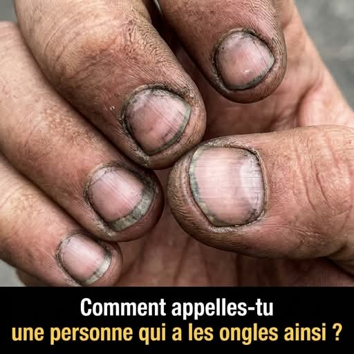 Comment appelle-t-on une personne qui a des ongles comme ça ?