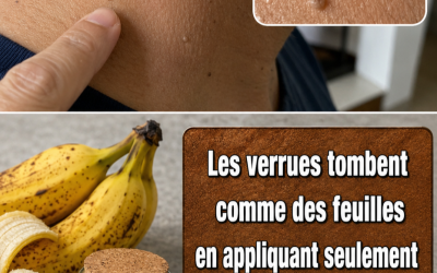 Pelure de banane et autres ingrédients naturels pour le traitement des verrues