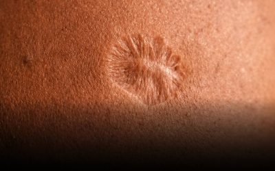 Cicatrice du vaccin contre la variole : pourquoi cela se produit-il ?