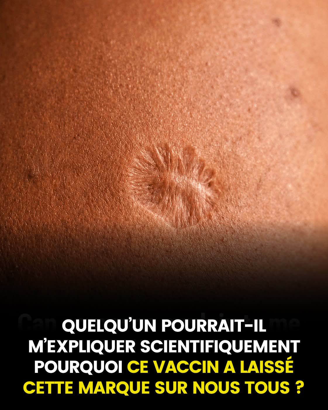 Cicatrice du vaccin contre la variole : pourquoi cela se produit-il ?