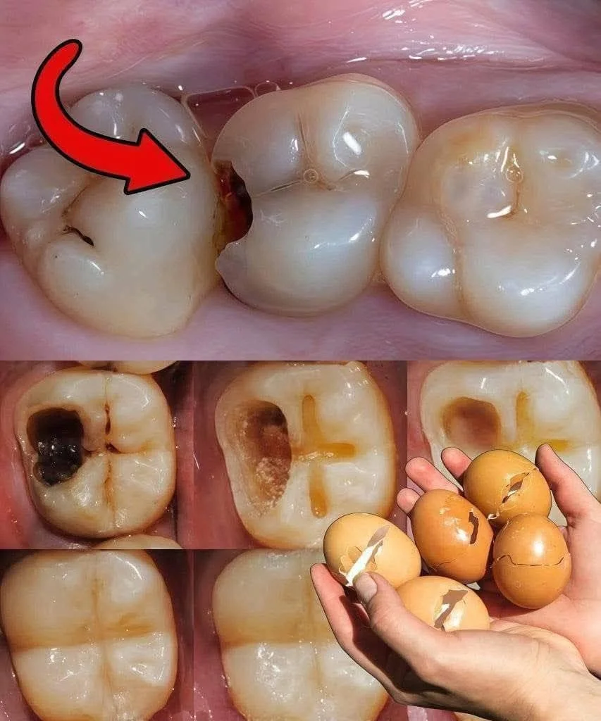 En 5 minutes, les dents jaunes deviennent d’un blanc nacré — Le secret