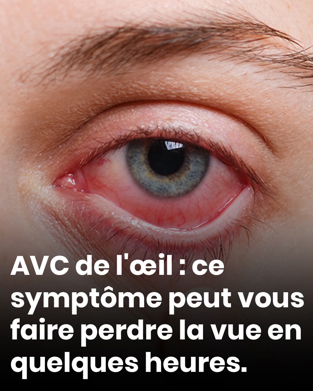 AVC de l’œil : ce symptôme peut vous faire perdre la vue en quelques heures